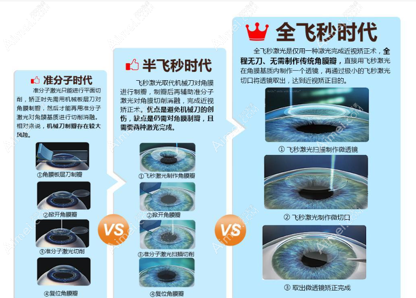 表层激光近视手术优缺点有哪些 表层激光近视手术优缺点有哪些