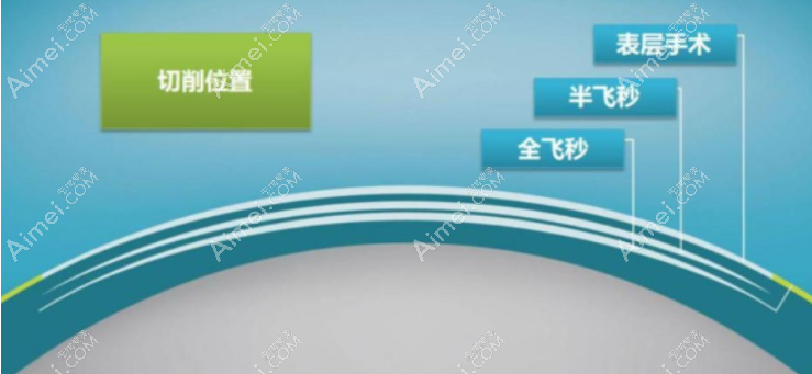 近视眼表层手术多少钱 近视眼表层手术多少钱