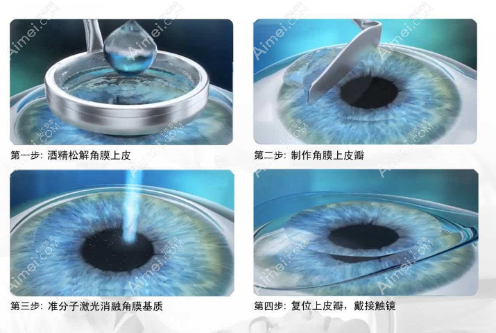 表层激光近视手术仪器和价格 表层激光近视手术仪器和价格