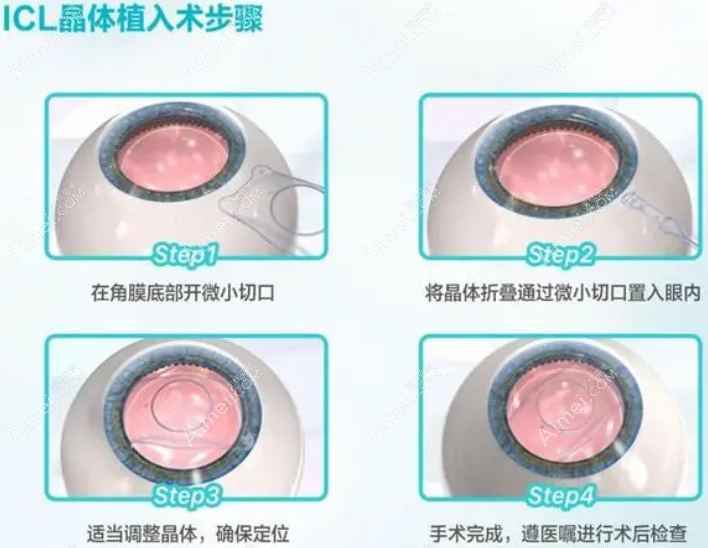 高度近视做晶体植入矫正怎么样 aimei.com