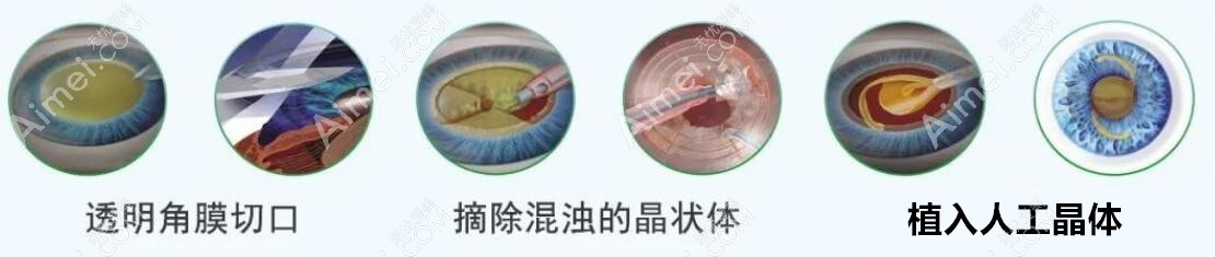 白内障手术和icl晶体植入不相同:区别有治疗症状,方法,价格