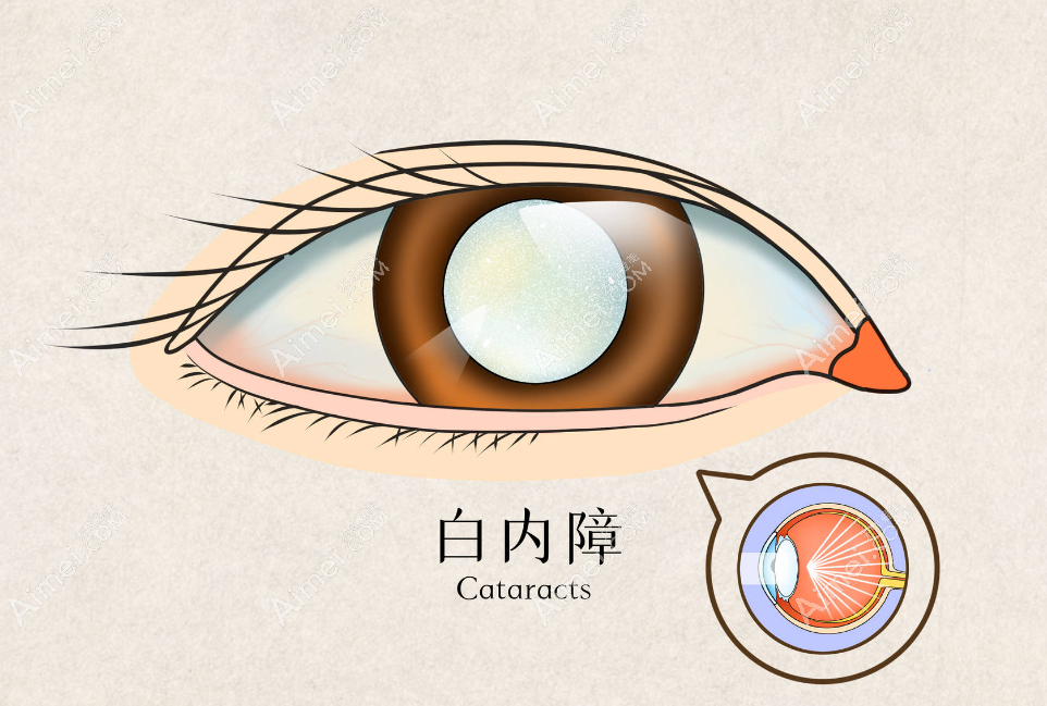 白内障人工晶体价格大概多少钱