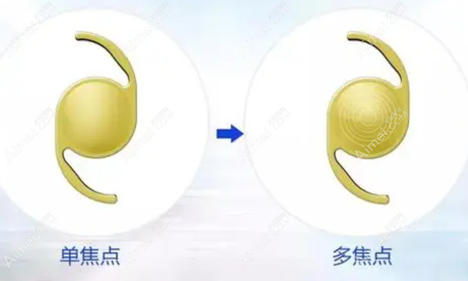 白内障人工晶体2023价目表大全