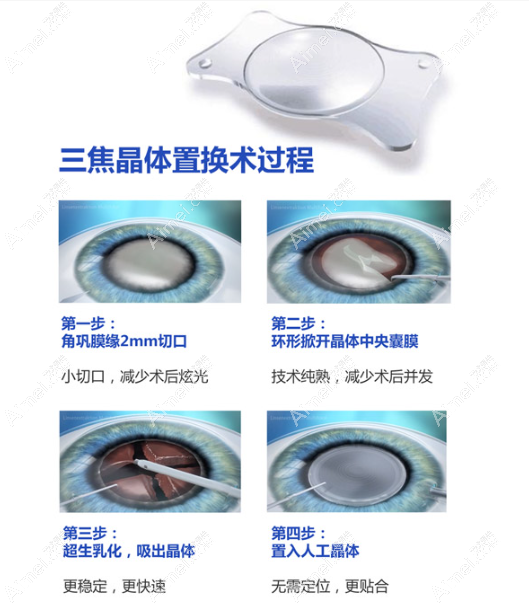 德国蔡司双焦点人工晶体价格
