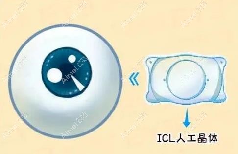 杭州icl晶体植入近视眼手术价格多少钱