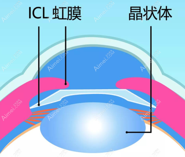 icl晶体植入手术过程aimei.com
