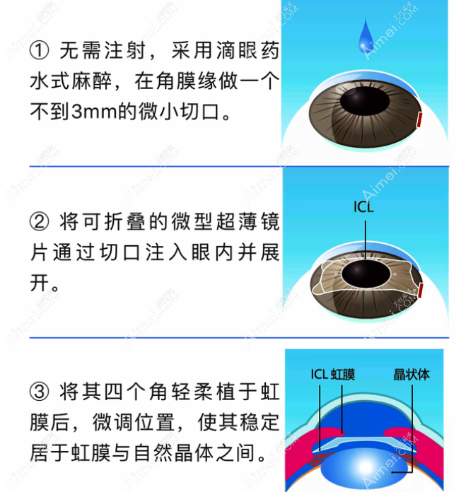 ICL晶体植入手术怎么做