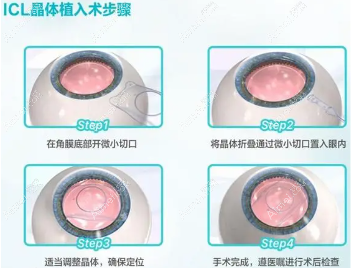 成都高度近视眼做晶体植入手术多少钱 成都高度近视眼做晶体植入手术多少钱