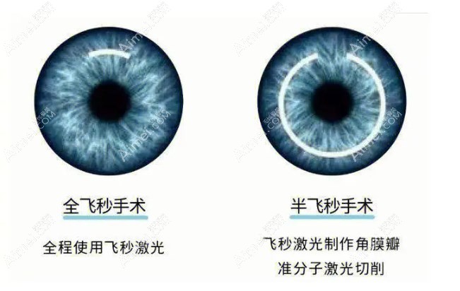 惠州飞秒手术价格