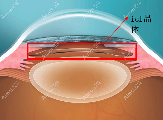 惠州icl近视手术价格