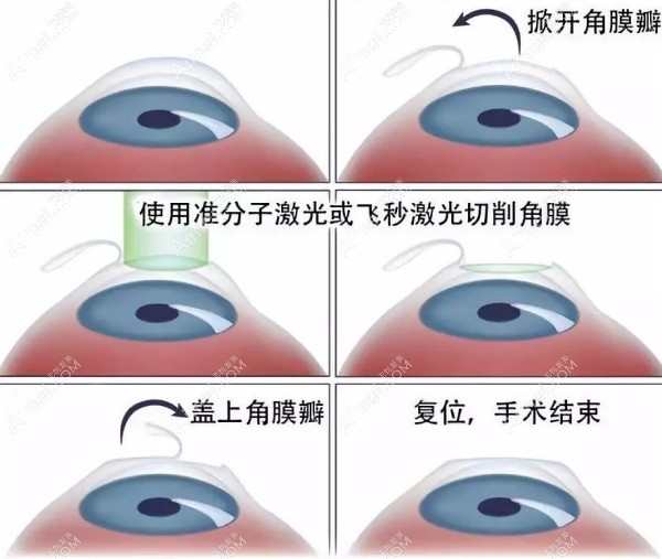 半飛秒激光手術(shù)圖解aimei.com