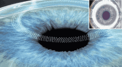 半飞秒手术过程