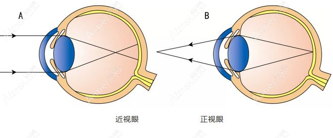 南京近视眼手术价格8800元起