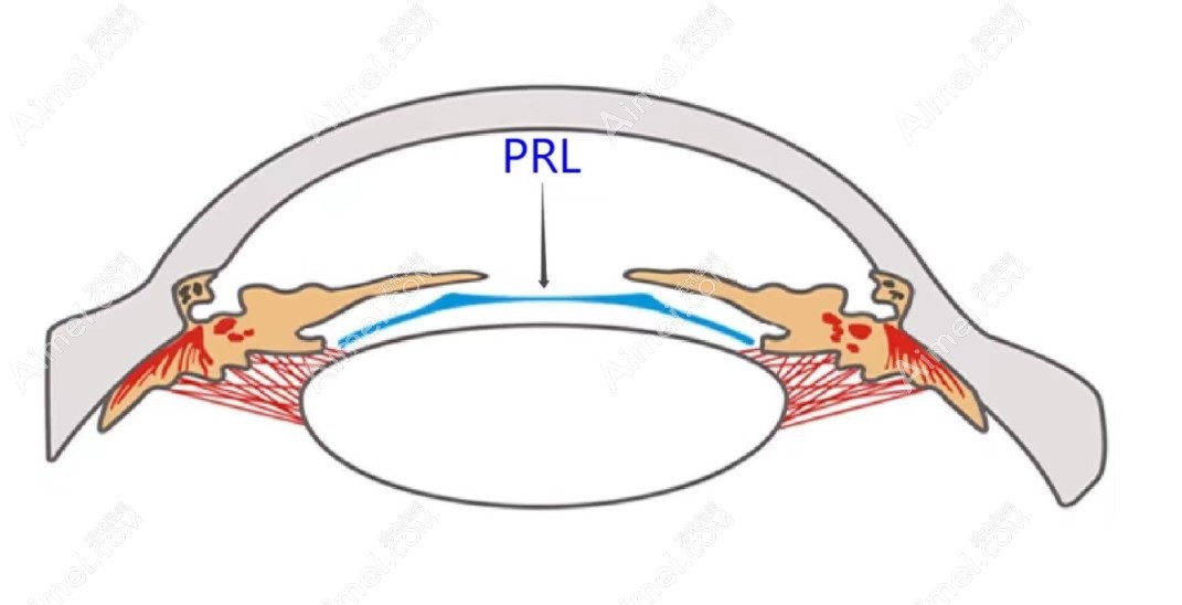 PRL晶体植入术能治多少度近视