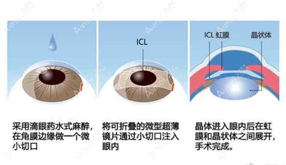 icl晶体植入近视眼手术可以做第二次吗