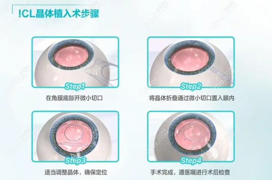 上海icl晶体植入怎么做