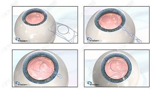 安徽合肥近视眼700度/900度/1000度手术价目表m.aimei.com