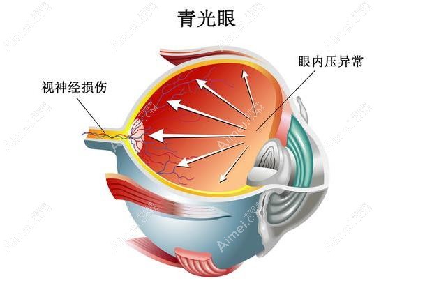 青光眼周边虹膜切除术价格