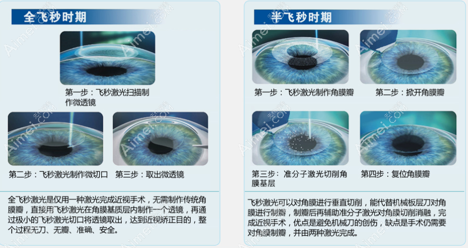 北京愛爾眼科全飛秒和半飛秒手術(shù)過程