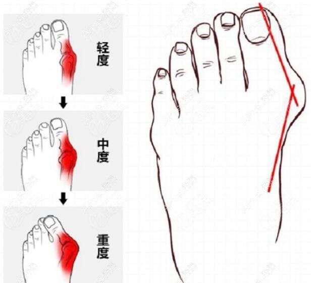 大腳骨輕重程度愛美網(wǎng)