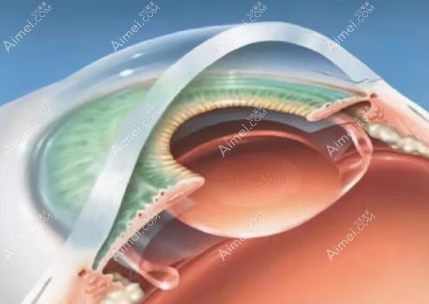 人工晶体植入手术费用多少钱?ICL-蔡司-爱尔康晶体价格2000起