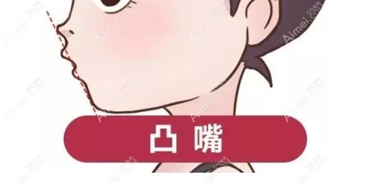 重庆松山医院正颌凸嘴手术价格