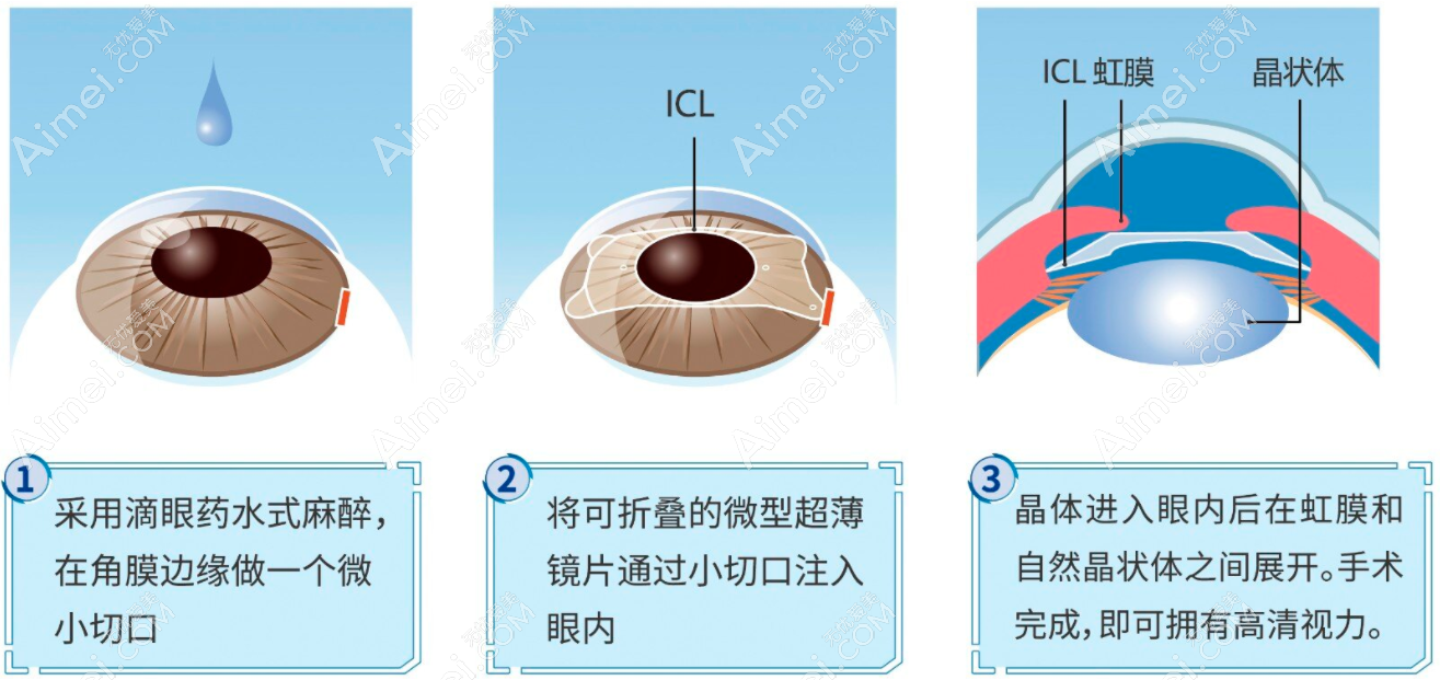 icl人工晶体植入手术费用