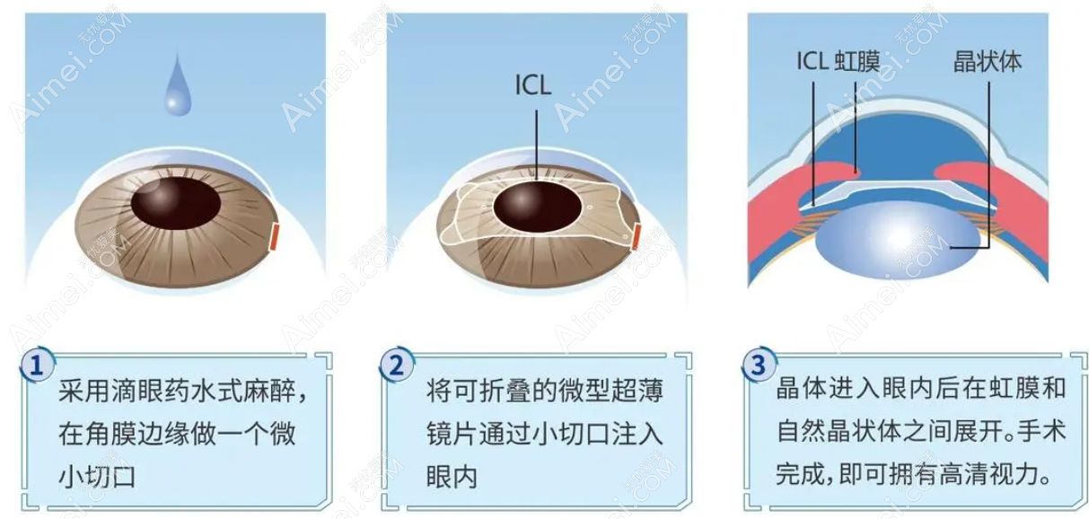 icl晶体植入近视手术过程