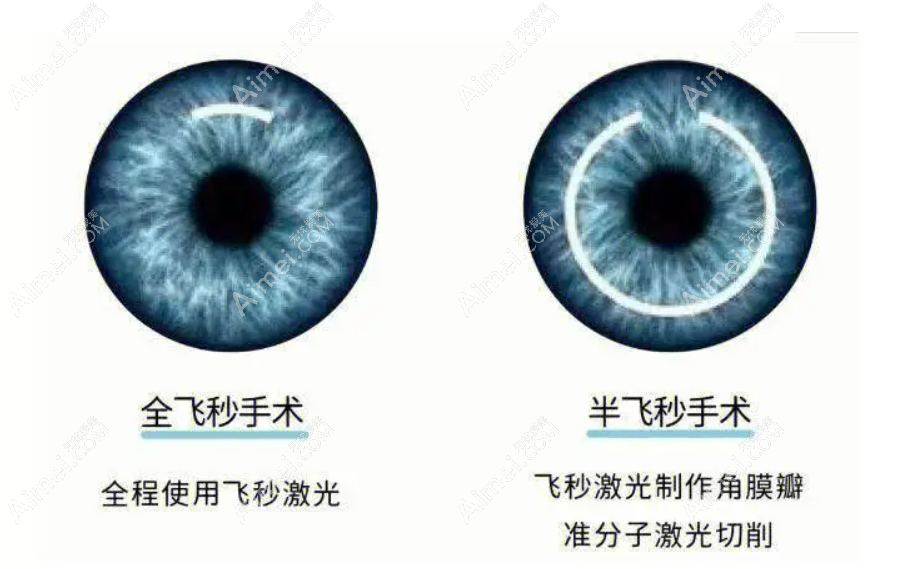 上海半飞秒手术价格