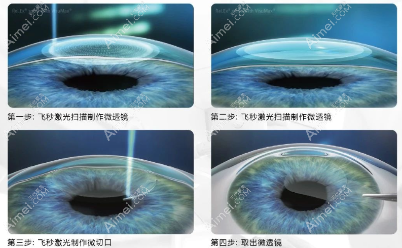 愛(ài)爾眼科醫(yī)院全飛秒激光近視手術(shù)價(jià)格多少錢
