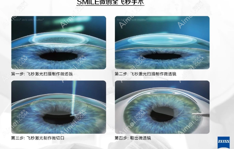 上海全飞秒手术价格
