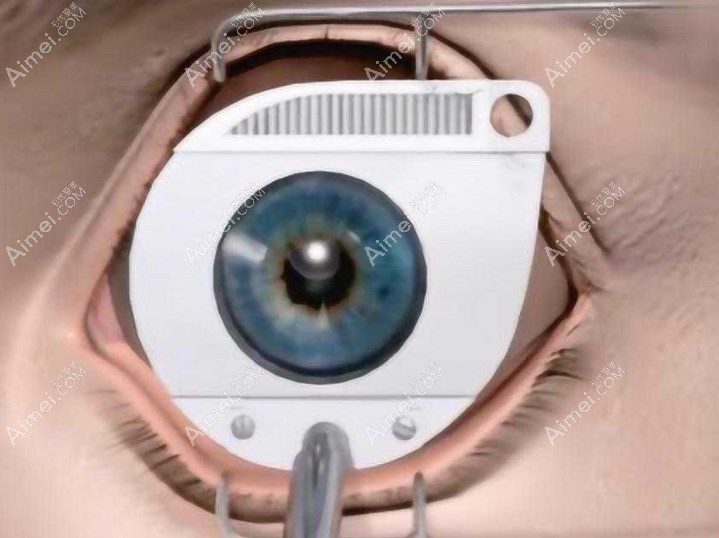 汕头正规眼科中心近视激光手术具体流程m.aim/ei.com 汕头正规眼科中心近视激光手术具体流程m.aim/ei.com