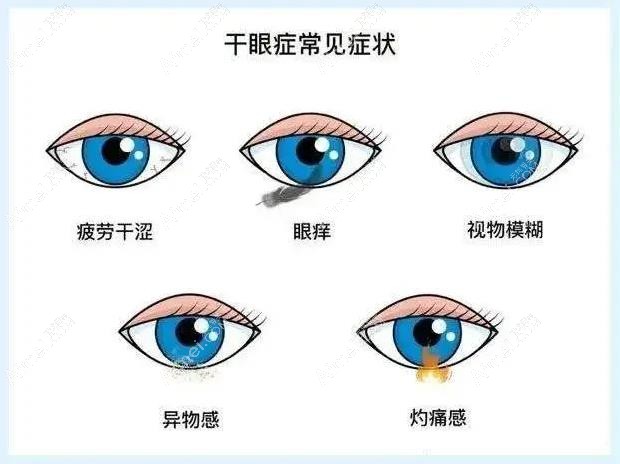 干眼症有哪些症状表现