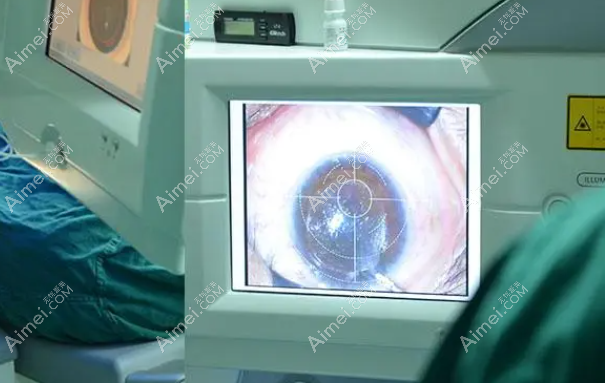 遵义近视手术费用6000-35000元-遵义恒爱眼科飞秒近视手术6800+