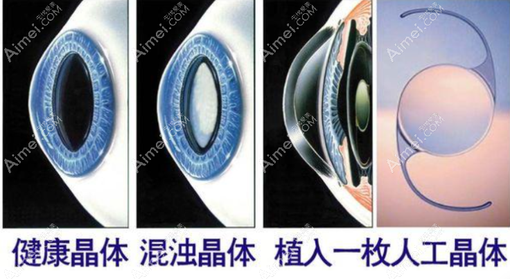 1700、2800、3000、4000、5000、8000、9000人工晶体是个什么水平