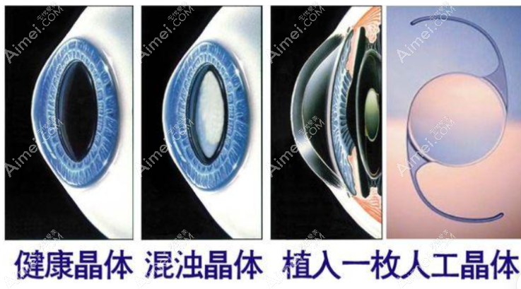 白内障人工晶体植入前后对比图片