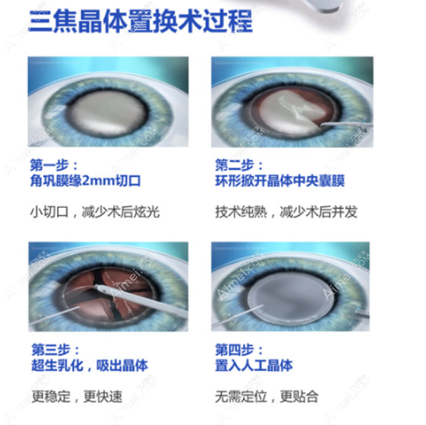 年轻人得了白内障晶体用三焦晶体比较好