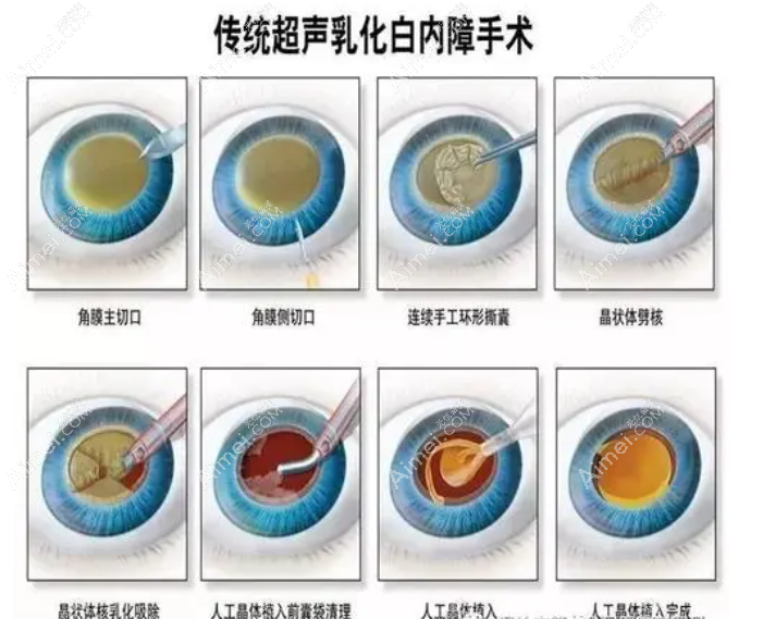 上海年轻人白内障手术费用和方法