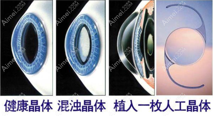 为什么上海老年人做白内障手术价格比年轻人和儿童便宜