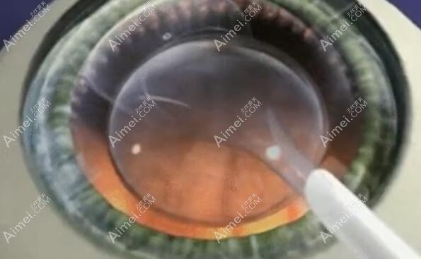 王从毅做ICL晶体植入近视手术多少钱