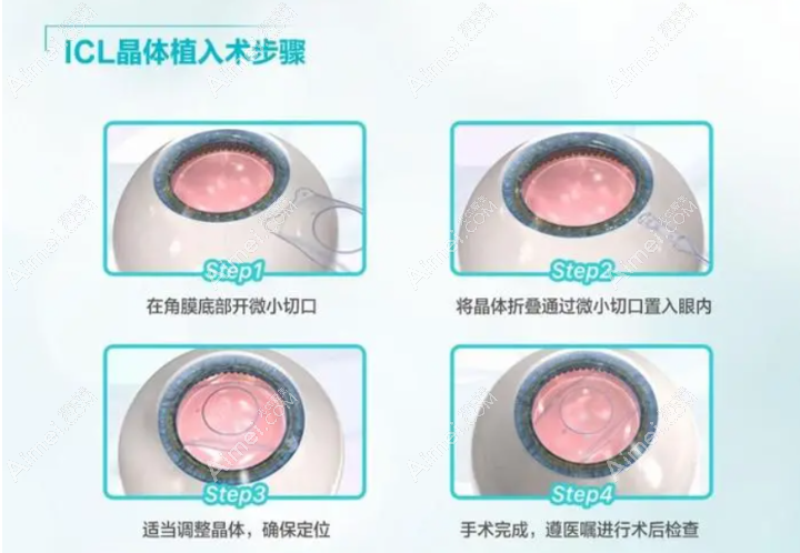 廉井财做icl晶体手术怎么样