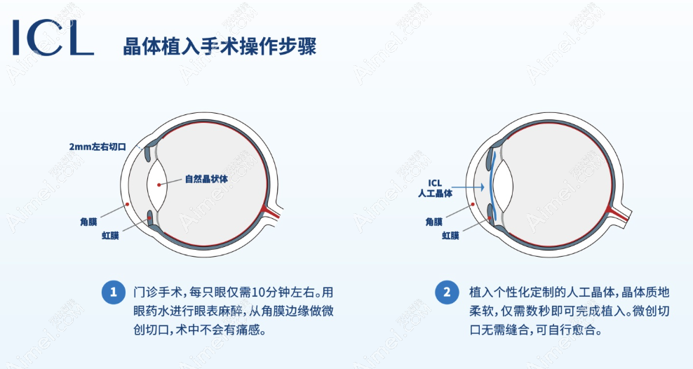 福州icl晶体植入近视手术过程和步骤