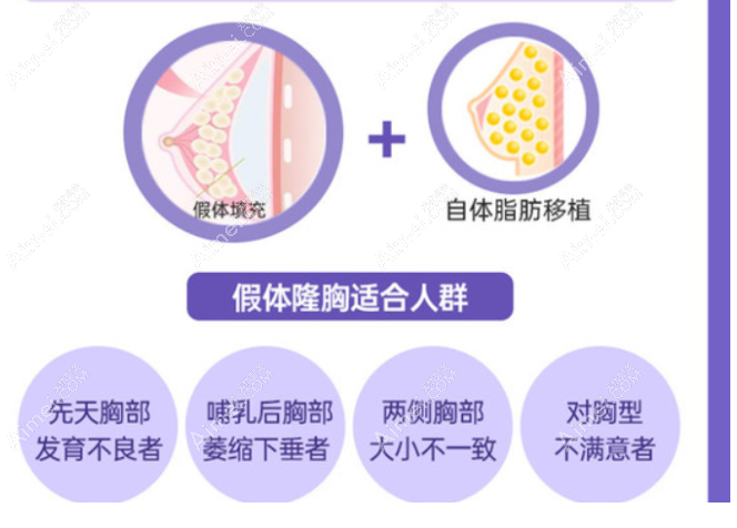傲諾拉和曼托假體隆胸適合人群