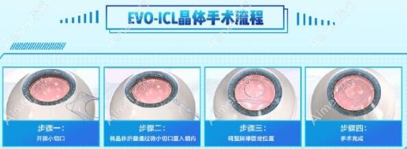 王从毅做ICL晶体植入m.aimei.com