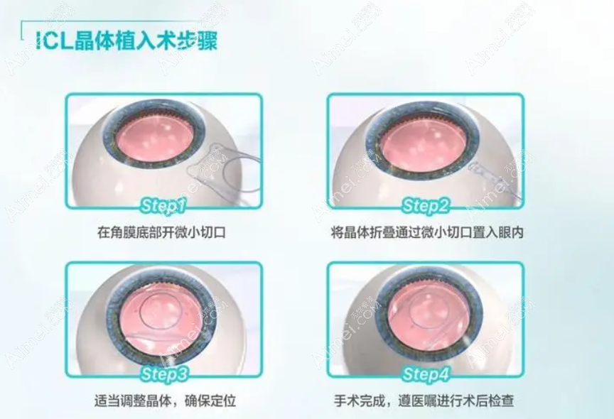 近视晶体植入手术过程