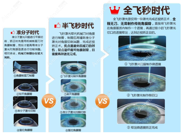 激光近视手术方法有哪些