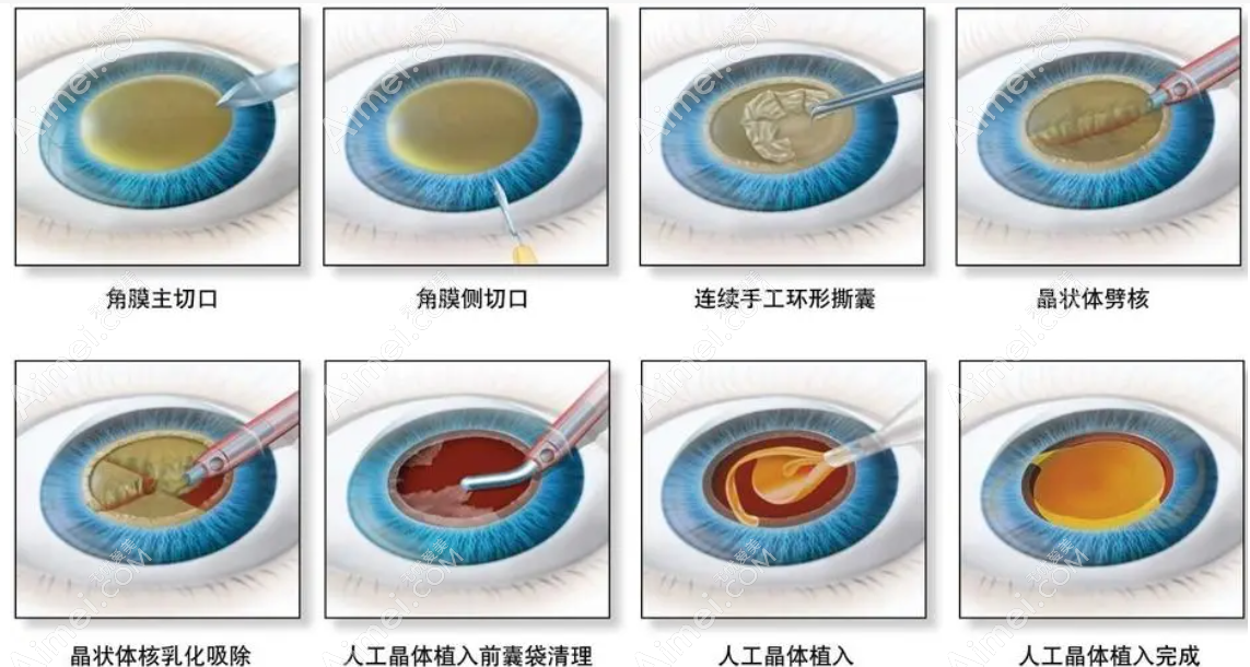 老年人换单焦晶体的缺点