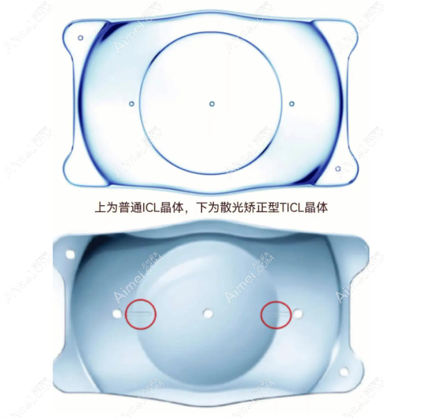 高度近视加散光晶体植入费用aimei.com