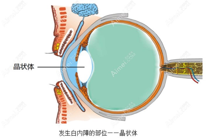 老年人白内障晶体选择