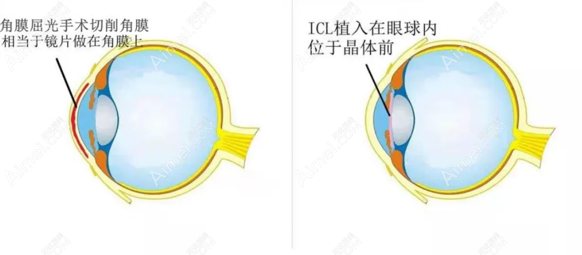 激光近视眼手术和icl晶体植入手术区别